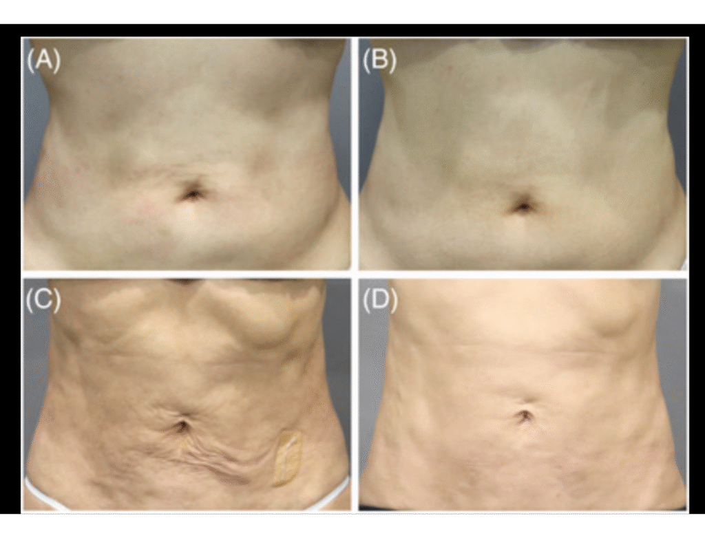 fibrose